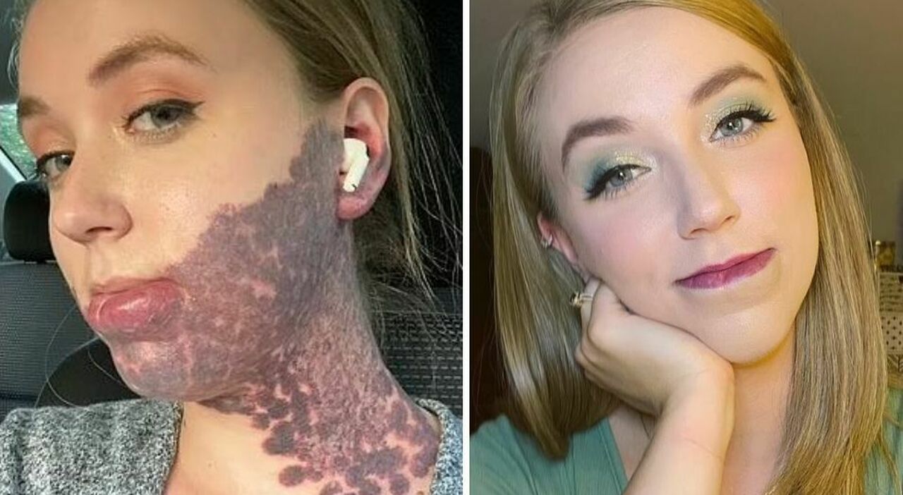 Woman Goes Through 20 Surgeries To Remove A Dangerous Birthmark